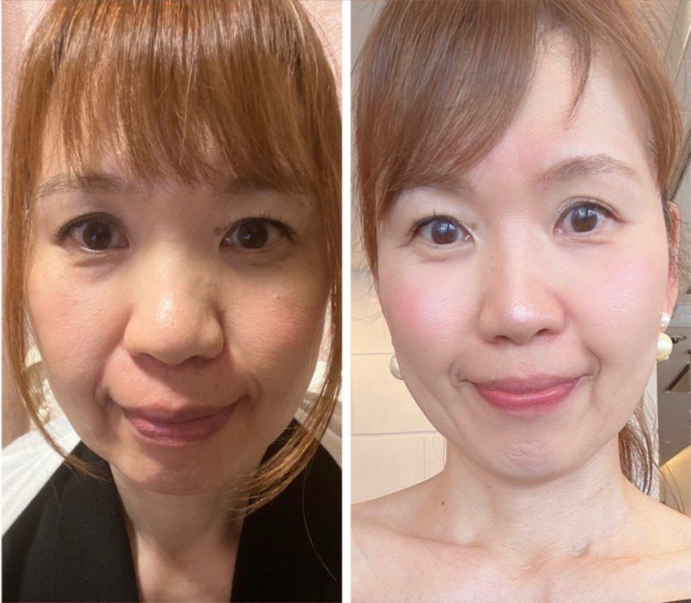 直美 ビフォーアフター
